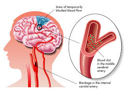 Image result for stroke pada otak