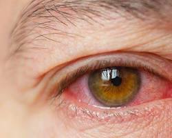 Image of person with dry eyes