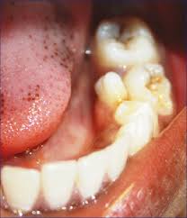 Image result for caries due to supernumerary