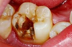 「歯 欠ける」の画像検索結果