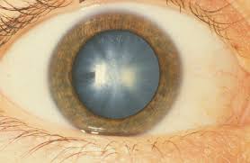 Enfermedades oculares: cataratas
