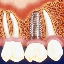 Dental implant graphic