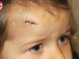 Résultats de recherche d'images pour « bébé avec cicatrice au front images »