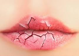 Image result for how to cure cracked lips