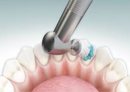 Image result for Dental prophy image