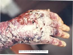 Image result for mrsa skin disease