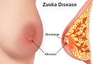 zuskas disease
