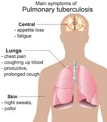 Image result for tuberculosis