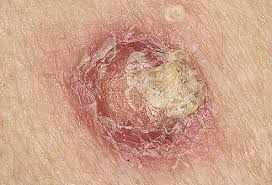 squamous cell carcinoma, caused by sun, removed
                  with PLANTAGO leaf juice and some ALOE VERA sap on
                  top