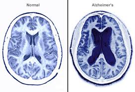 Image result for alzheimer's disease