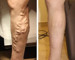 What is,varicose,veins