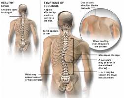 Image result for scoliosis