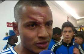 Así quedó el jugador Jhonny Ramírez tras la, grosera, agresión que le cometió Gerardo Bedoya, jugador de Independiente Santa Fe. Archivo particular - IMAGEN-12245560-2