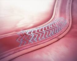 صورة Bioresorbable stent