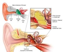 Image of Ear Infection