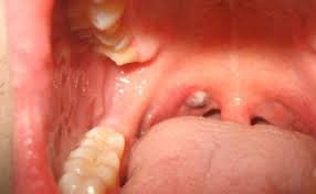 Image result for tonsil stones images