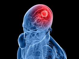 Image result for Vaccine Targeting Brain Tumors Seems Safe in Study