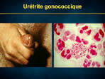 Infection gonococcique
