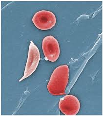 Image result for 1995 - Researchers from the U.S. National Institutes of Health announced that clinical trials had demonstrated the effectiveness of the first preventative treatment for sickle cell anaemia.