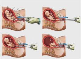 Resultado de imagen de Aborto y embarazadas