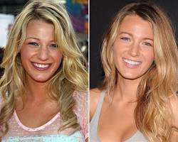 Imagen de Blake Lively before and after plastic surgery