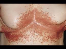 Image result for bacterial skin infection
