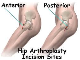 Image result for posterior hip replacement precaution