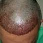 Haartransplantation: Nie wieder Geheimratsecken - so geht s