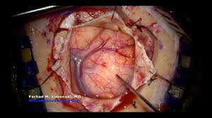 Surgery for resection of brain tumor. Large metastatic brain tumor ...