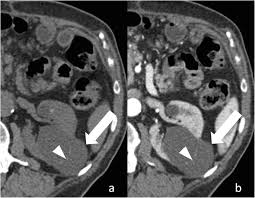 CT and MR imaging of cystic renal lesions | Insights into Imaging ...