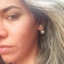 Ex-BBB Adriana faz peeling e posta foto com rosto descascando - GLAMOUR | Hot news - adriana