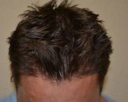 Amincissement des cheveux