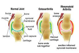 Image result for arthritis