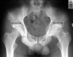 Image result for hip osteoarthritis