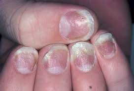 Image result for PSORIASIS