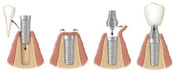Image result for hình implant răng