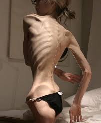 anorexia nervosa, eating disorder