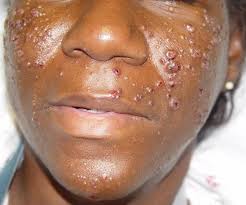 Image result for cryptococcosis skin