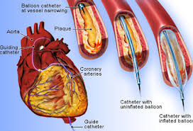 Image result for heart disease