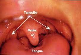 தொண்டை  சதை  அழற்சி  நோய் (Tonsillitis)