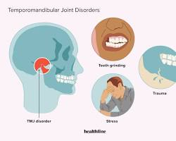 Image of TMJ Disorder