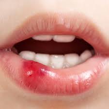 Image result for lip wound