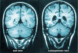 Early Intervention is Very Important in Schizophrenia