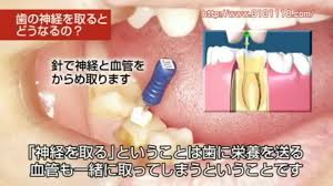 「歯の神経 site:http://www.8181118.com/」の画像検索結果