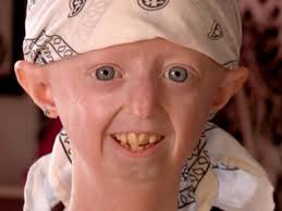 Resultado de imagen para progeria