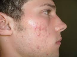 Acne Skin Care Methods