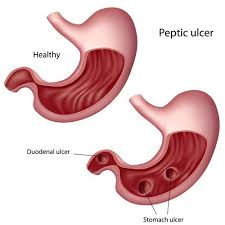 Image result for peptic ulcer disease images without a copyright