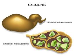 Image result for gallstones