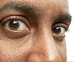Expert Warns: Igbo and Yoruba Elderly Men Face Heightened Risk of Glaucoma-Induced Blindness - 1