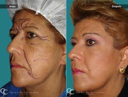 ... Ritidoplastia-Dr-Gerardo-camacho (2). La Ritidoplastia o Estiramiento Facial. La operación de Rejuvenecimiento facial o Lifting Facial conocida ... - ritidoplastia-dr-gerardo-camacho-2